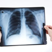 X-ray of lungs doctor holding in hands